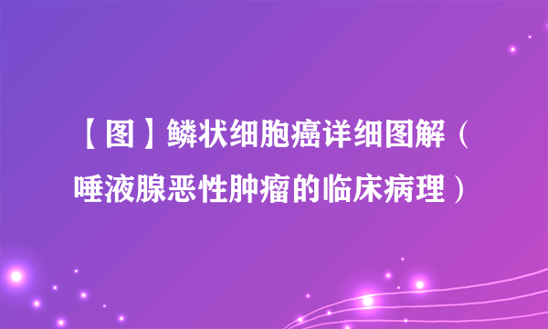 【图】鳞状细胞癌详细图解（唾液腺恶性肿瘤的临床病理）