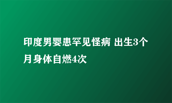 印度男婴患罕见怪病 出生3个月身体自燃4次