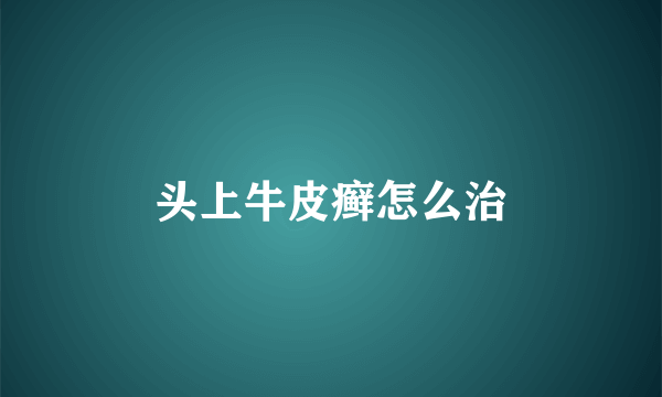 头上牛皮癣怎么治