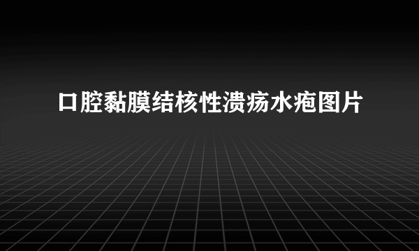 口腔黏膜结核性溃疡水疱图片