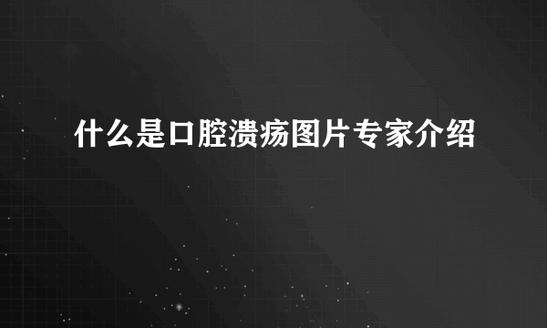 什么是口腔溃疡图片专家介绍