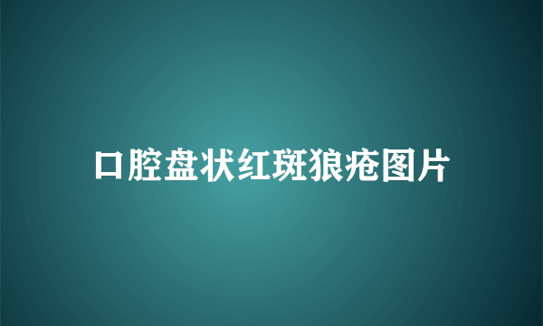 口腔盘状红斑狼疮图片